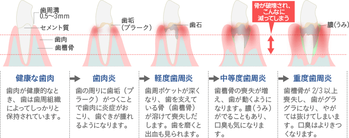 歯周病の進行の様子